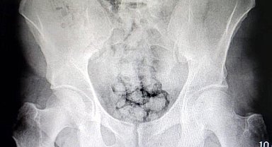 Uyuşturucuları midelerine sakladılar, polis tarafından kıskıvrak yakalandılar