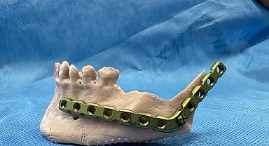 3D modelleme üzerinde test yapıldı, ardından hastaya uygulandı