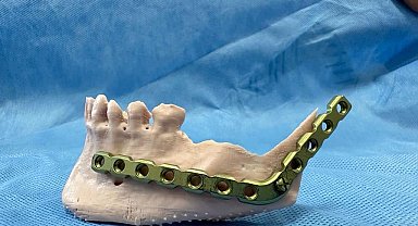 Türkiye'de nadir yapılan uygulama ile Sivaslı hasta sağlığına kavuştu